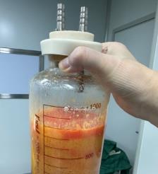 大竹水动力吸脂手术要做多久？